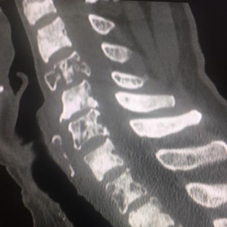 3° caso clinico Benedetta scoliosi!