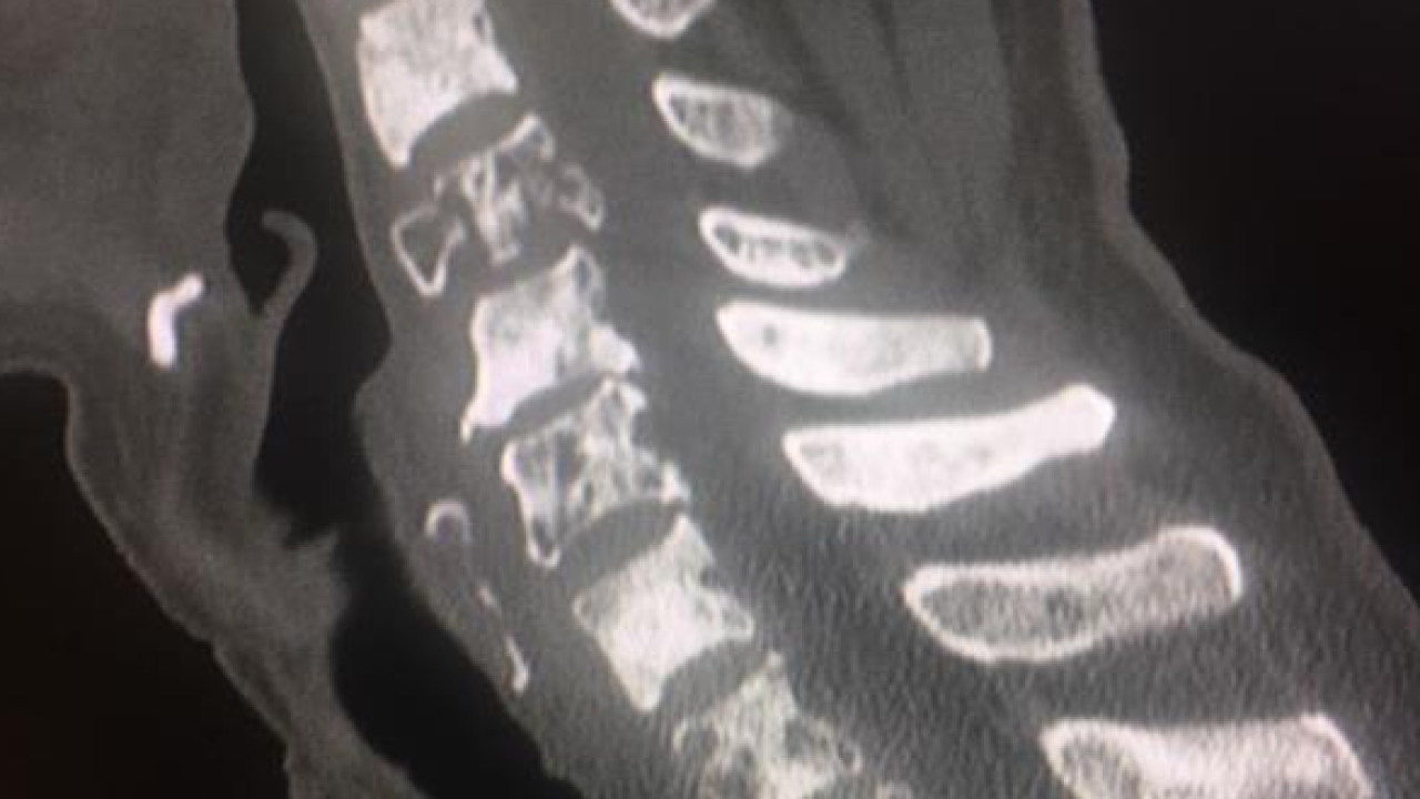 3° caso clinico Benedetta scoliosi!